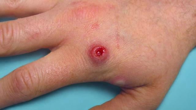 Intellectus Monkeypox et quomodo impedire?