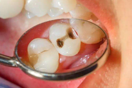 Babio launches profectus caries locupletandum medium enim diluculo dente labe deprehensio